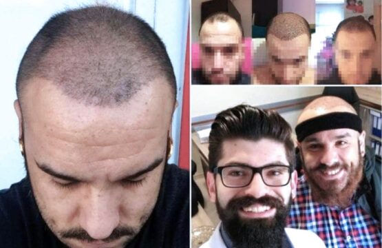 trapianto-di-capelli-in-turchia_